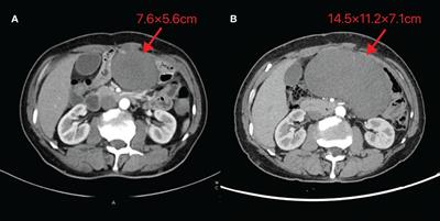 Case report: Rapidly progressive desmoid tumor after surgery for esophagogastric junction cancer and slowly progressive primary desmoid tumor: a report of two cases and literature review